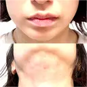 ボトックス（エラ・小顔） / 脂肪溶解注射（顔） / 脂肪溶解注射 渋谷美容外科クリニック 渋谷院 DAY 1 サムネイル用