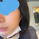 光治療（フォトフェイシャルなど） 椿クリニック 名古屋院 DAY 4 サムネイル用