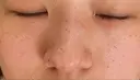 ピコスポット Olino美容外科・美容皮膚科 DAY 7 サムネイル用