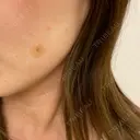 ほくろ・いぼ切除（肌） 心斎橋形成外科スキンケアクリニック DAY 7 サムネイル用