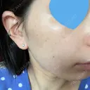 光治療（フォトフェイシャルなど） 椿クリニック 名古屋院 DAY 6 サムネイル用