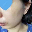 光治療（フォトフェイシャルなど） 椿クリニック 名古屋院 DAY 6 サムネイル用