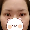 二重切開 / 目頭切開 / 眼瞼下垂（切開） / 目元修正 聖心美容クリニック 札幌院 DAY 16 サムネイル用