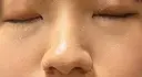 ピコスポット Olino美容外科・美容皮膚科 AFTER サムネイル用