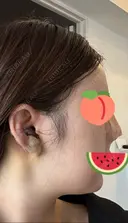 隆鼻術 / 鼻尖形成（切開） / 鼻中隔延長（切開） エースクリニック 名古屋院 DAY 3 サムネイル用