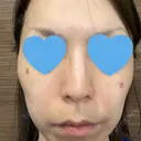 シミ取りレーザー / ピコレーザートーニング（美白・肝斑） フローラクリニック DAY 1 サムネイル用