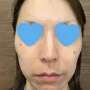 シミ取りレーザー / ピコレーザートーニング（美白・肝斑） フローラクリニック DAY 3 サムネイル用