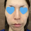 シミ取りレーザー / ピコレーザートーニング（美白・肝斑） フローラクリニック DAY 4 サムネイル用