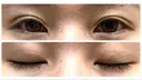 二重埋没 アリエル美容クリニック 郡山院 DAY 6 サムネイル用
