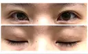 二重埋没 アリエル美容クリニック 郡山院 AFTER サムネイル用