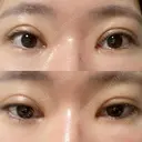 二重切開 / 目頭切開 聖心美容クリニック 札幌院 DAY 44 サムネイル用