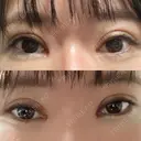二重切開 / 目頭切開 聖心美容クリニック 札幌院 DAY 28 サムネイル用