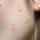 ボトックス（エラ・小顔） TCB東京中央美容外科 大宮東口院 DAY 1 サムネイル用