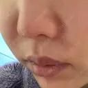 鼻翼基部形成（貴族手術） ジョウクリニック 大阪院 DAY 1 サムネイル用