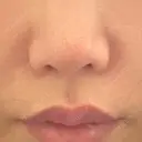 鼻翼基部形成（貴族手術） ジョウクリニック 大阪院 DAY 3 サムネイル用