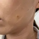 ほくろ・いぼ切除（肌） 心斎橋形成外科スキンケアクリニック DAY 11 サムネイル用