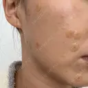 ほくろ・いぼ切除（肌） 心斎橋形成外科スキンケアクリニック DAY 11 サムネイル用