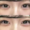 ヒアルロン酸注入（涙袋） / ボトックス（タレ目） アネシス美容クリニック DAY 0 サムネイル用