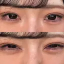 ヒアルロン酸注入（涙袋） / ボトックス（タレ目） アネシス美容クリニック AFTER サムネイル用