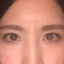 二重埋没 アリエル美容クリニック 郡山院 DAY 15 サムネイル用