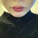 ヒアルロン酸注入（あご） アネシス美容クリニック AFTER サムネイル用