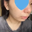 光治療（フォトフェイシャルなど） 椿クリニック 名古屋院 AFTER サムネイル用