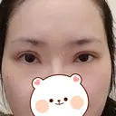 二重切開 / 目頭切開 / 眼瞼下垂（切開） / 目元修正 聖心美容クリニック 札幌院 DAY 21 サムネイル用