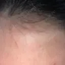ダーマペン LIFIX BEAUTY CLINIC DAY 3 サムネイル用