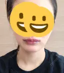 ルフォー+ssro（両あご) / 口角挙上 / ヒアルロン酸注入（唇） / ボトックス（口角） / その他（口元） HB整形外科 DAY 7 サムネイル用