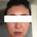 その他（輪郭） / 輪郭修正 ニューセンス皮膚科クリニック DAY 7 サムネイル用