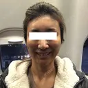 その他（輪郭） / 輪郭修正 ニューセンス皮膚科クリニック DAY 14 サムネイル用