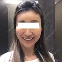 その他（輪郭） / 輪郭修正 ニューセンス皮膚科クリニック DAY 21 サムネイル用