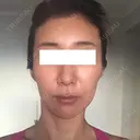 その他（輪郭） / 輪郭修正 ニューセンス皮膚科クリニック AFTER サムネイル用