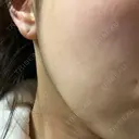 ピーリング（ニキビ・毛穴） まゆりなclinic 名古屋栄 DAY 0 サムネイル用