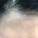 ダーマペン LIFIX BEAUTY CLINIC DAY 5 サムネイル用