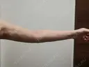脂肪吸引（二の腕） オアシス美容外科 DAY 10 サムネイル用