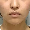 鼻翼基部形成（貴族手術） / ボトックス（あご） / ボトックス（口角） 大阪TAクリニック AFTER サムネイル用