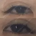 二重埋没 Olino美容外科・美容皮膚科 DAY 0 サムネイル用