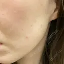 ほくろ・いぼ切除（肌） 心斎橋形成外科スキンケアクリニック AFTER サムネイル用