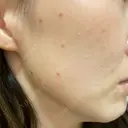 ほくろ・いぼ切除（肌） 心斎橋形成外科スキンケアクリニック DAY 15 サムネイル用