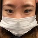クマ治療 NARU Beauty Clinic 【ナルクリ】 AFTER サムネイル用