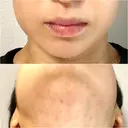 ボトックス（エラ・小顔） / 脂肪溶解注射（顔） / 脂肪溶解注射 渋谷美容外科クリニック 渋谷院 AFTER サムネイル用