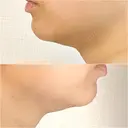 ボトックス（エラ・小顔） / 脂肪溶解注射（顔） / 脂肪溶解注射 渋谷美容外科クリニック 渋谷院 DAY 15 サムネイル用