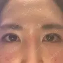 二重埋没 アリエル美容クリニック 郡山院 DAY 24 サムネイル用