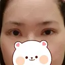 二重切開 / 目頭切開 / 眼瞼下垂（切開） / 目元修正 聖心美容クリニック 札幌院 DAY 28 サムネイル用