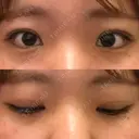 二重埋没 湘南美容クリニック 大阪心斎橋院 DAY 74 サムネイル用