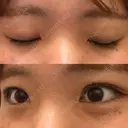 二重埋没 湘南美容クリニック 大阪心斎橋院 DAY 74 サムネイル用