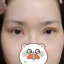 二重切開 / 目頭切開 / 眼瞼下垂（切開） / 目元修正 聖心美容クリニック 札幌院 AFTER サムネイル用