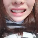 ガミースマイル手術 オーラルビューティークリニック白金 DAY 11 サムネイル用