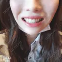 ガミースマイル手術 オーラルビューティークリニック白金 DAY 14 サムネイル用